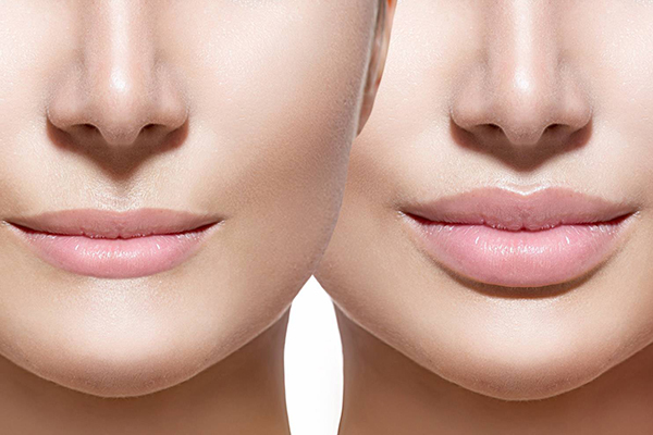 filler acido ialuronico