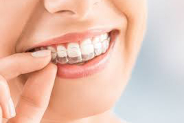 invisalign lite adulti
