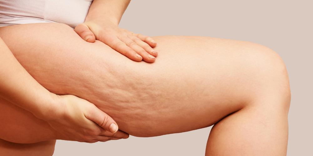 Cellulite o ritenzione idrica