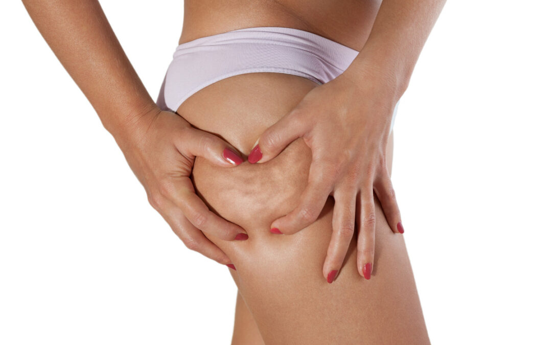 Cellulite e ritenzione idrica: due nemici comuni ma distinti