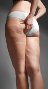 cellulite quando stringo