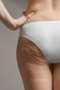 cellulite quando viene